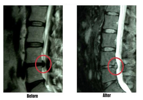 Chiropractic Canton MI IDD Therapy Treatment Before And After